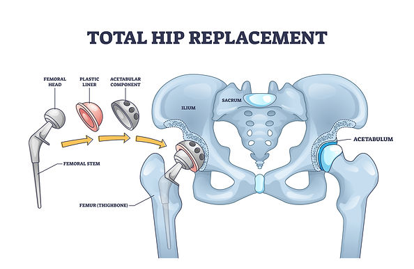 total-hip-replacement-mr-jonathan-white-consultant-orthopaedic-hip